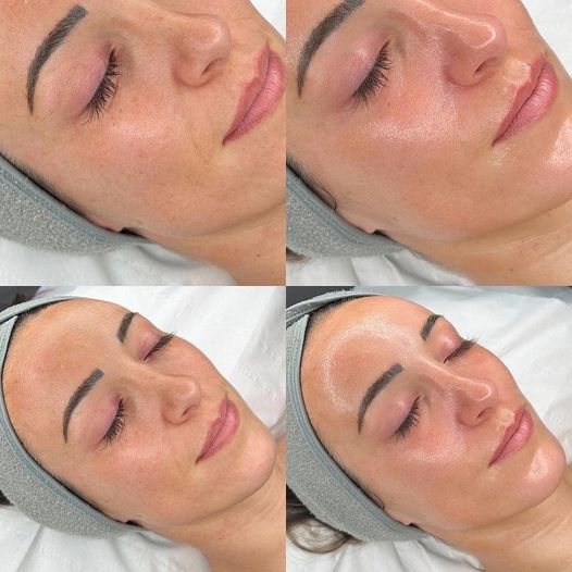 Процедура Hydrafacial дарує шкірі миттєве сяйво.